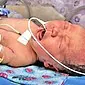 Liečba asfyxie u novorodencov