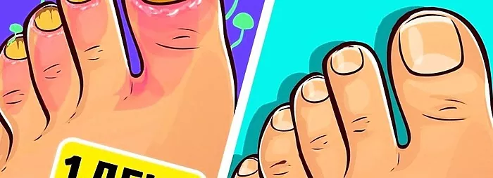 درمان مایکوز: انتخاب بهترین درمان برای قارچ ناخن پا