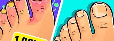 Leczenie grzybicy: wybór najlepszego środka na grzybicę paznokci