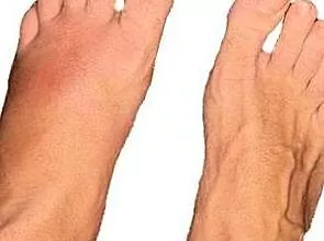שבר בעצם הרגליים ברגל: טיפול שמרני וכירורגי