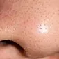 Ako sa zbaviť čiernych bodiek na nose?
