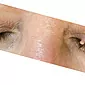 Hoe zich te ontdoen van papilloma in het ooglid?