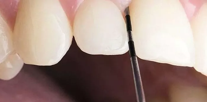 کورتاژ دندان چیست؟