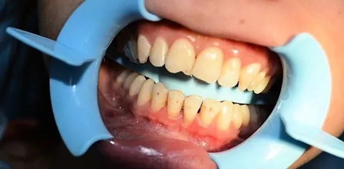 מהי גיזוז שיניים?
