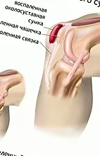 Apakah ancaman tumor lutut?