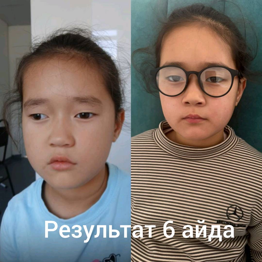 Графеновые очки . Лечить катаракты, сухость глаз, слезоточивось, аллергия и.д. - изображение 2