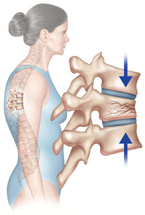 Osteoporoz (kemik erimesi) kırığa neden olabilien önemli bir hastalıktır