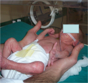 Read more about the article Prematüre Bebeklerin Değerlendirilmesi ve Rehabilitasyonu