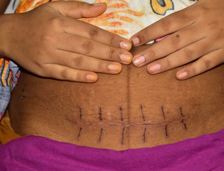 Woman's abdomen with caesarean section scar