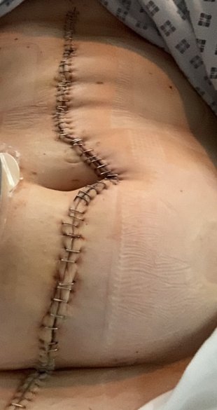 Lottie's surgical scar following the removal of her large intestine