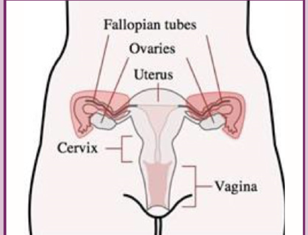 The Protector Study looks at a two step option during surgery to prevent ovarian cancer