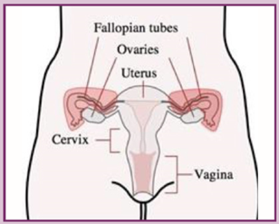 The Protector Study looks at a two step option during surgery to prevent ovarian cancer