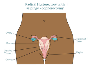 Radical-hysterectomy-with-salpingo-oopherectomy.original