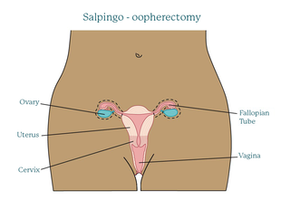 Salpingo-oophorectomy.original