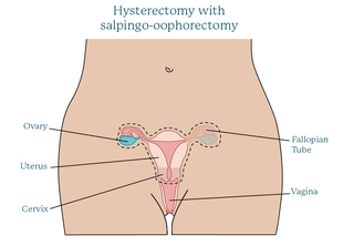 hysterectomy-with-salpingo-oophorectomy.original