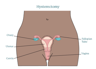 hysterectomy.original