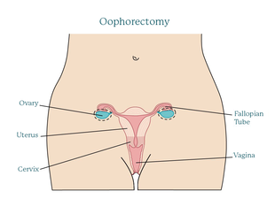 oophorectomy.original