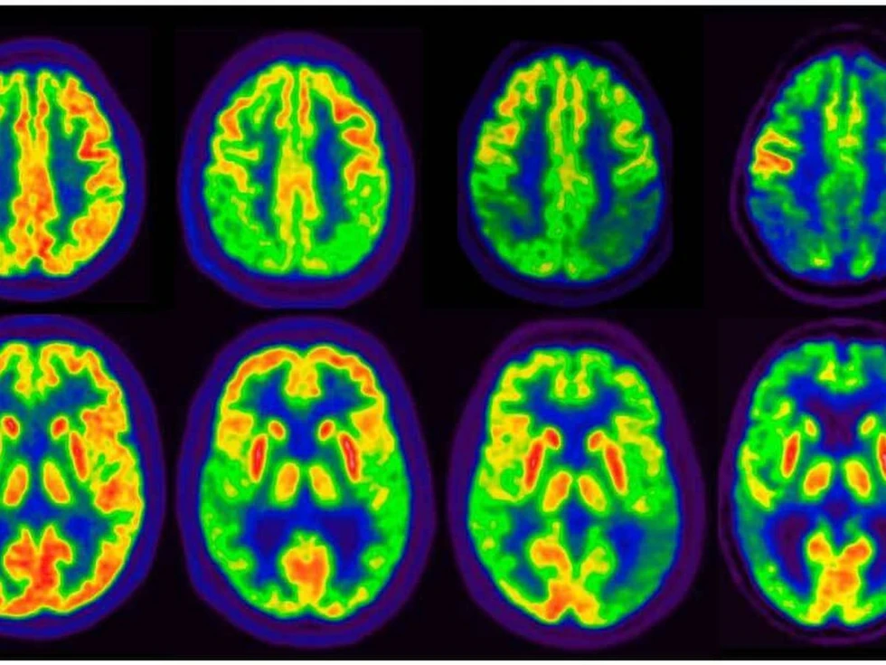 ¿Gas Xenón frente al Alzheimer?
