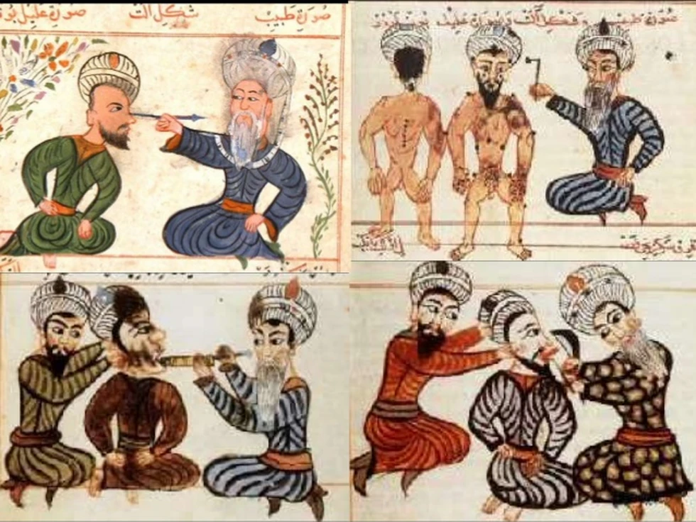 La curiosa historia de la operación de catarata...