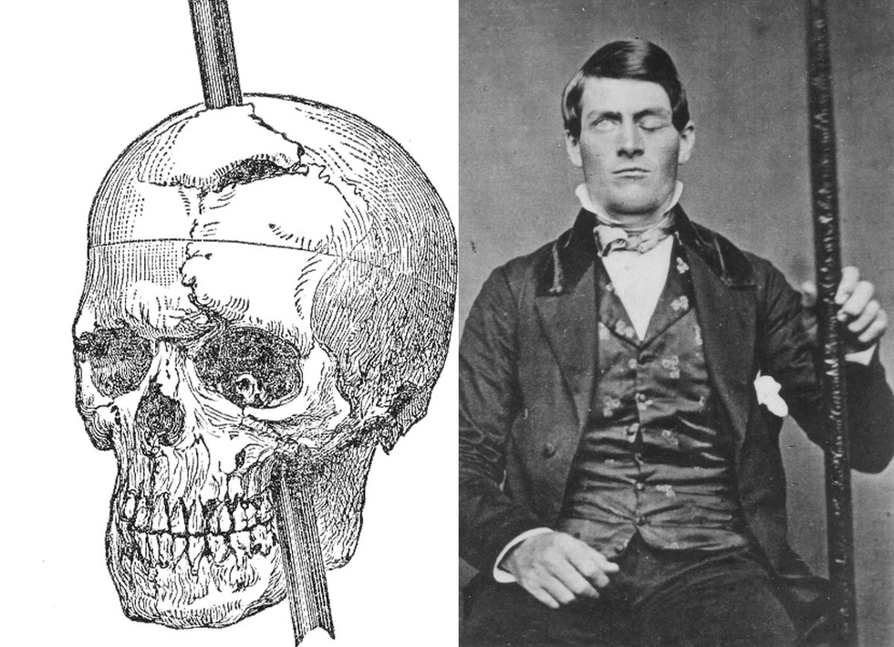 El insólito caso de Phineas Gage...